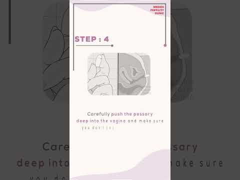 Vaginal Pessary : How to insert it during fertility treatment. #ivfjourney #ivfspecialist #fertility